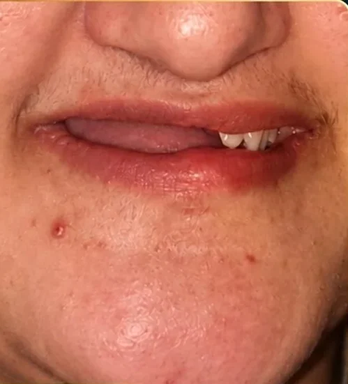 Multiple implants — smile restored — before