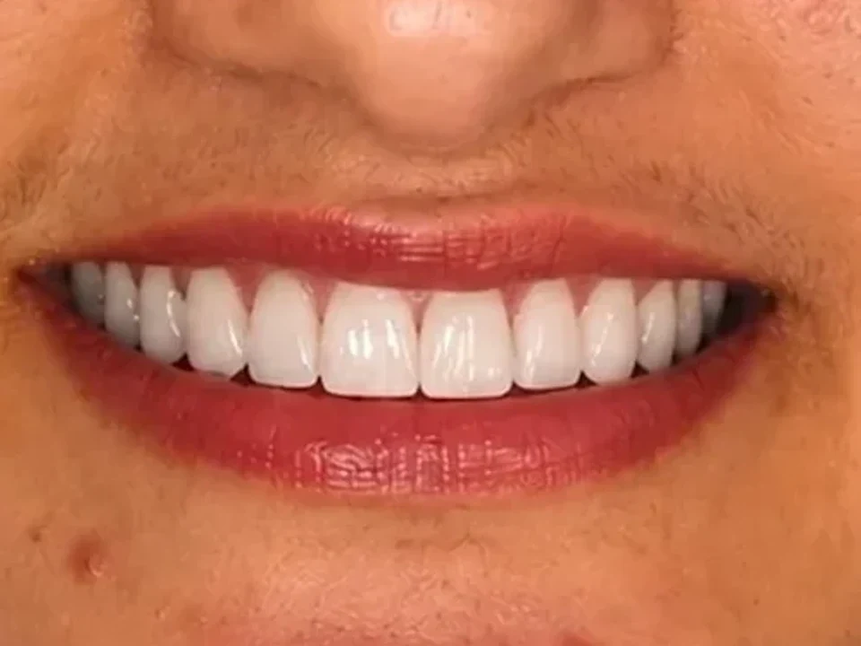 Multiple implants — smile restored — after