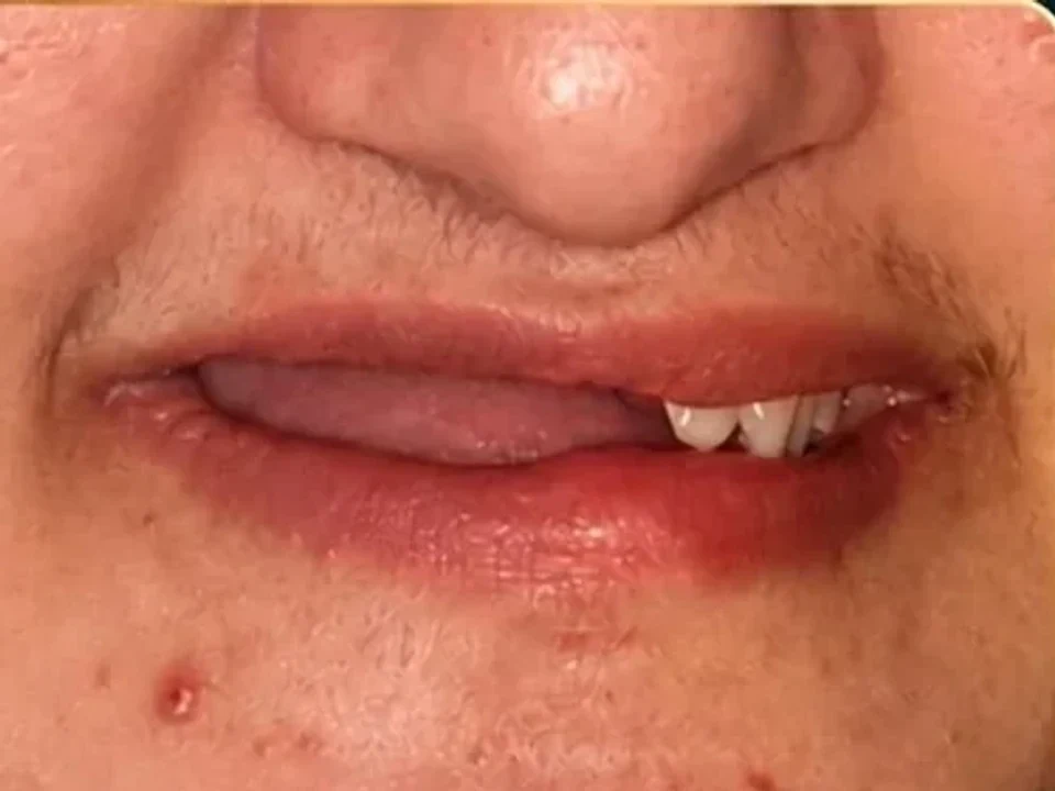 Multiple implants — smile restored — before
