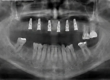 Panoramic X-ray before and after implants — after