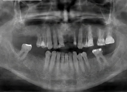 Panoramic X-ray before and after implants — before