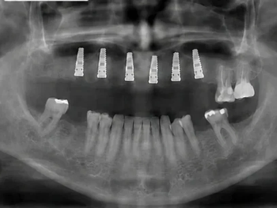 Panoramic X-ray before and after implants — after