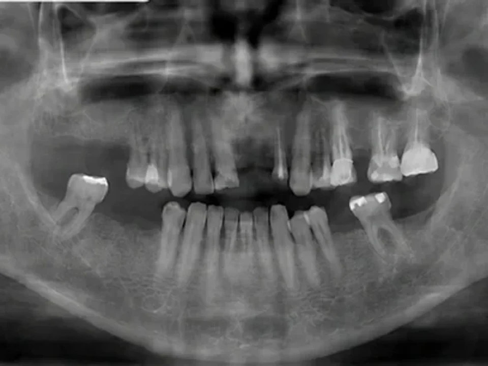 Panoramic X-ray before and after implants — before