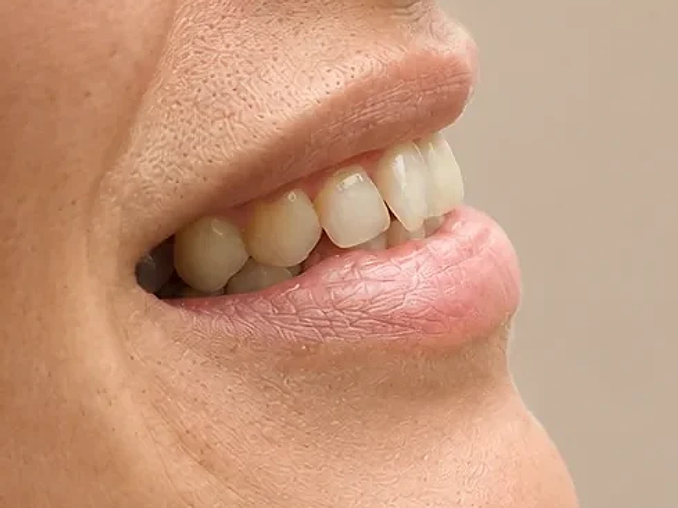 Facial profile transformation — before