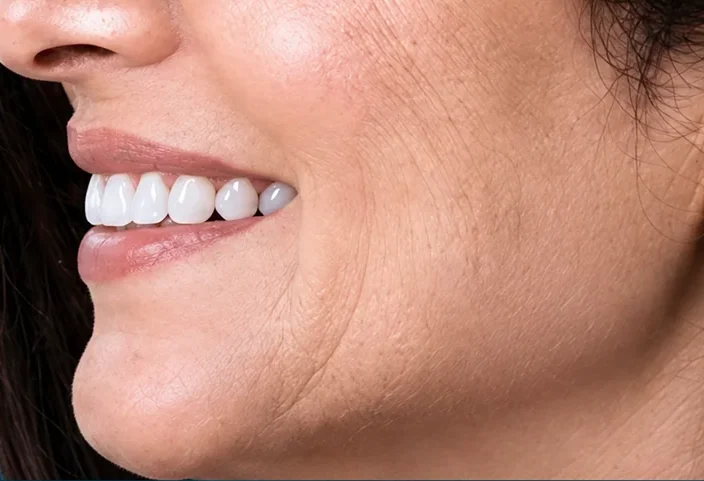 Profile before and after implants — after