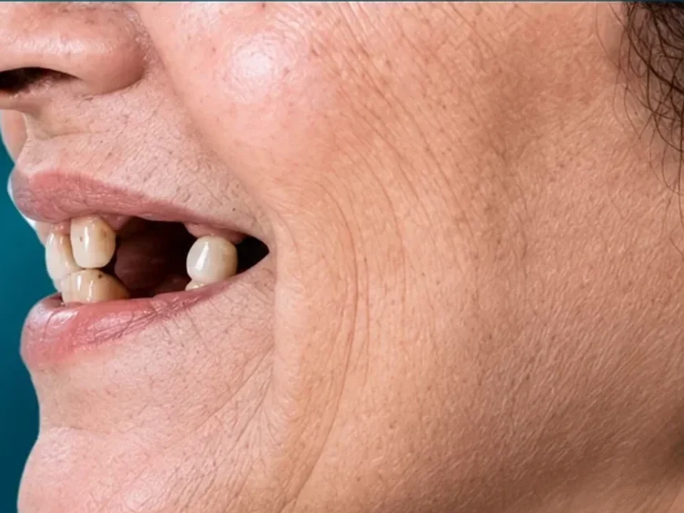 Profile before and after implants — before