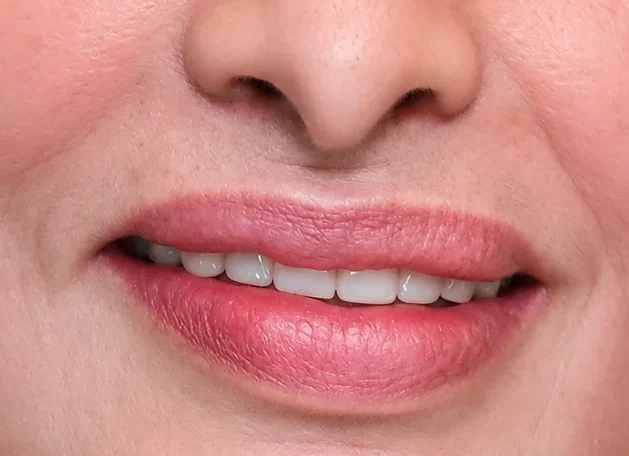 Restore your smile. Restore your confidence. — after
