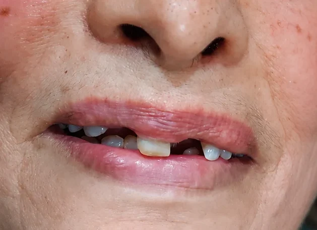 Restore your smile. Restore your confidence. — before