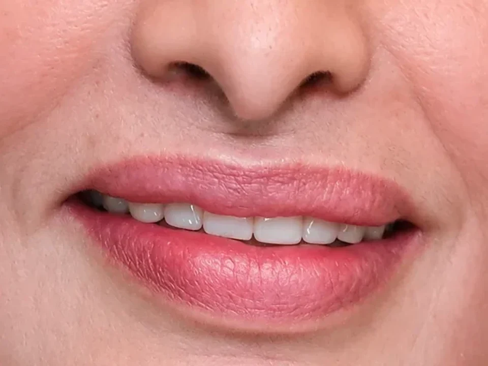 Restore your smile. Restore your confidence. — after