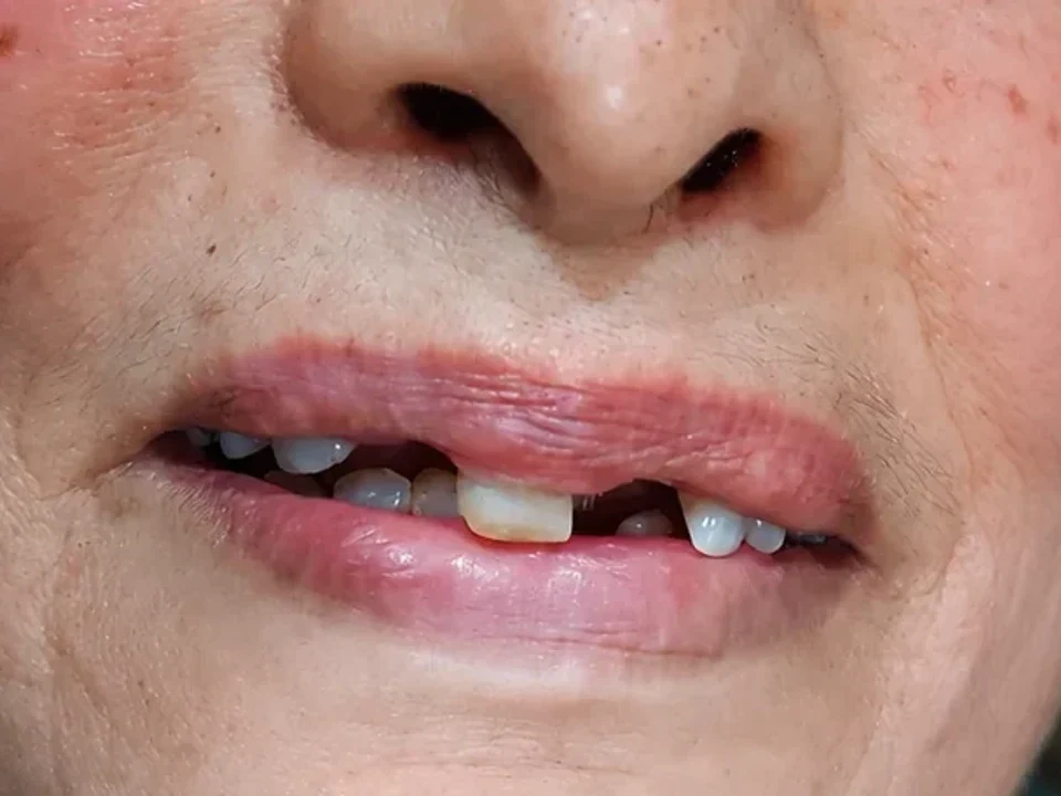 Restore your smile. Restore your confidence. — before