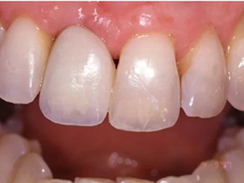 Implant and crown placement — after