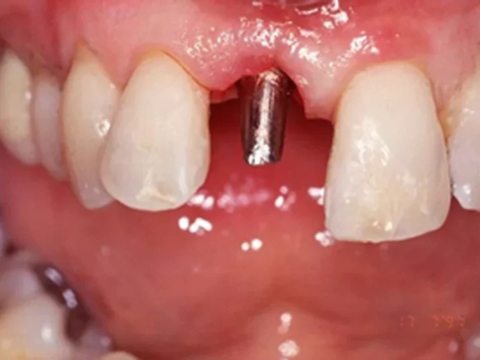 Implant and crown placement — before
