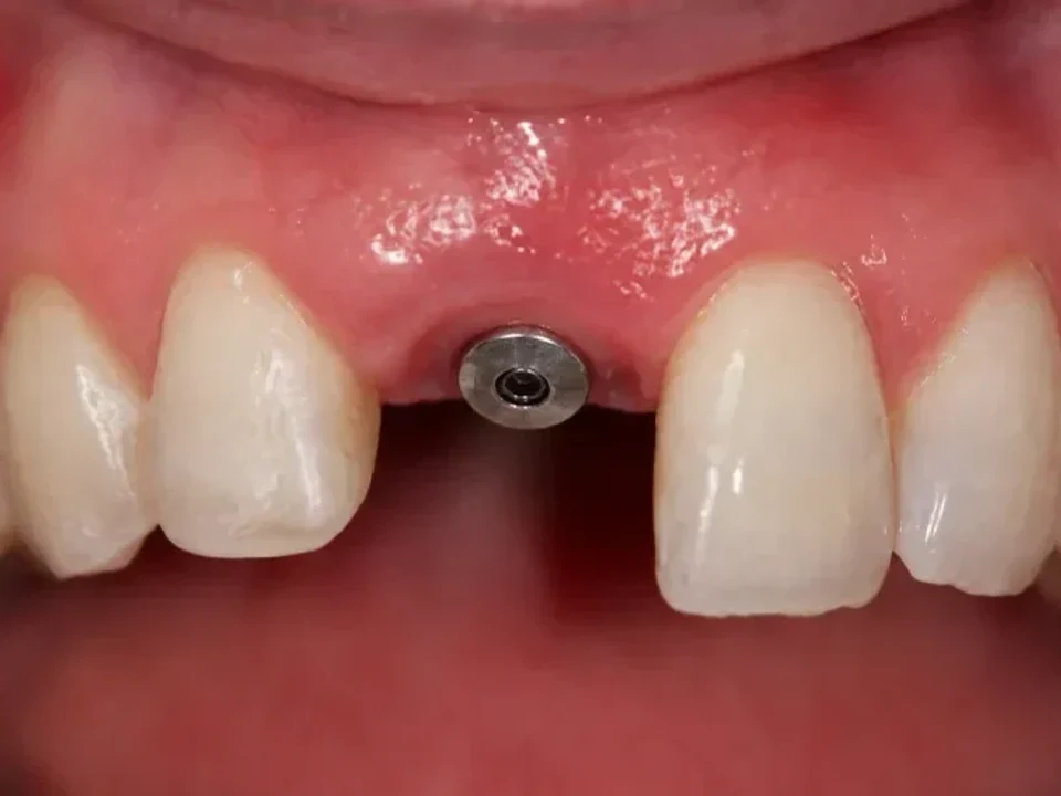 Missing front tooth restored with an implant — after