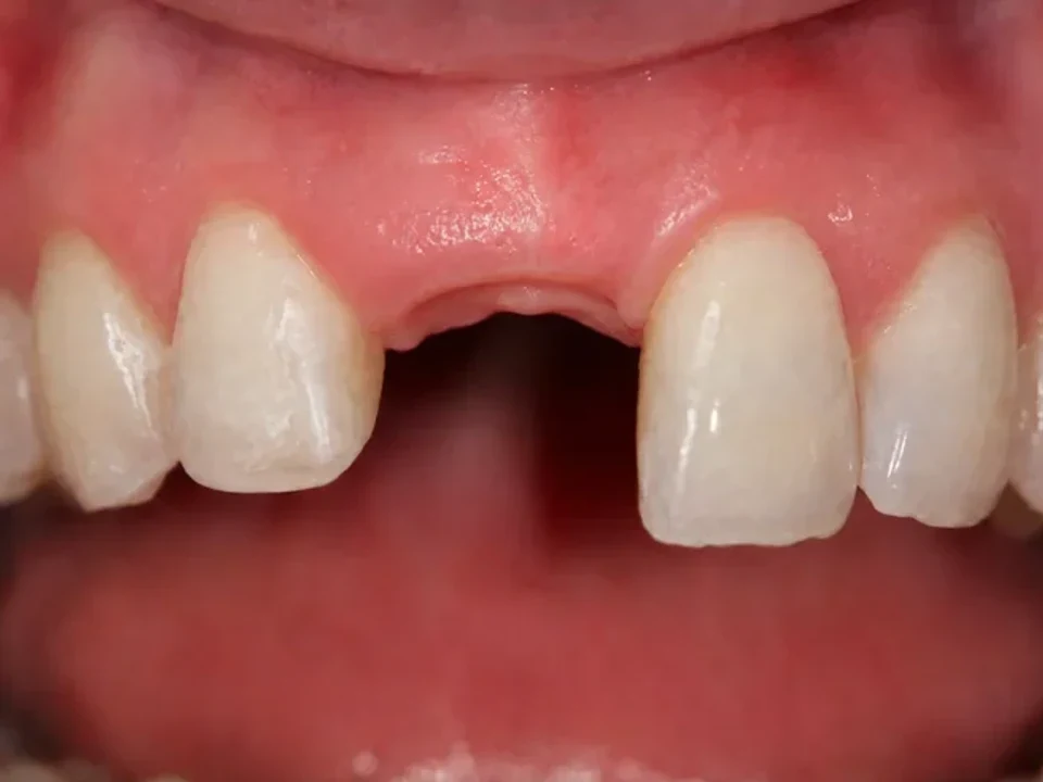 Missing front tooth restored with an implant — before
