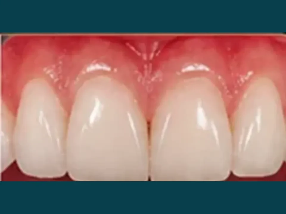Chipped or broken teeth repaired with precision veneers — after