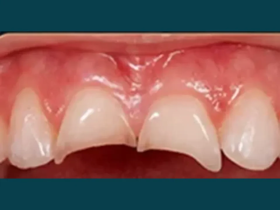 Chipped or broken teeth repaired with precision veneers — before
