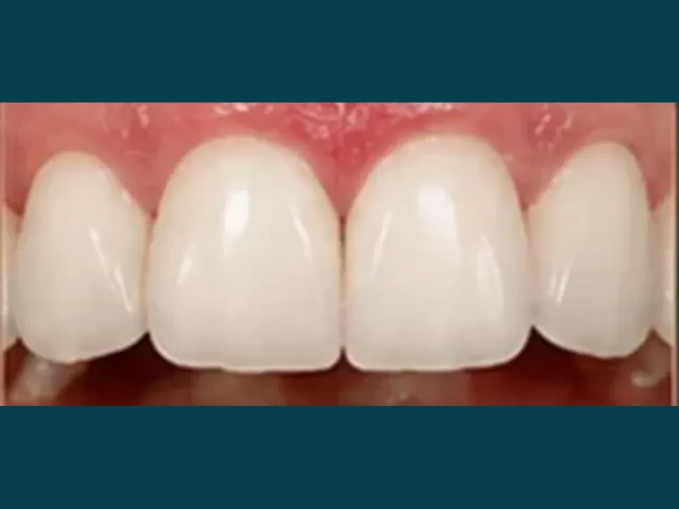 Decayed or damaged teeth restored with durable crowns — after