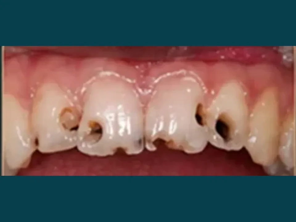 Decayed or damaged teeth restored with durable crowns — before