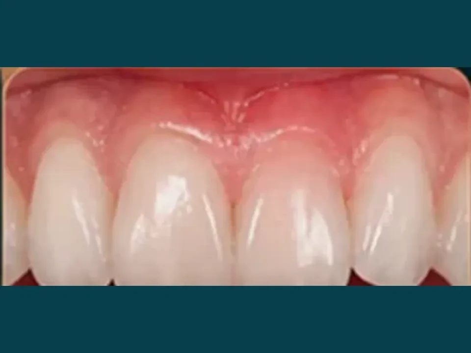 Gaps between teeth closed for a perfect smile — after