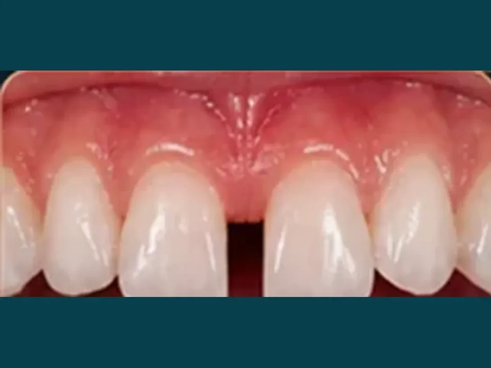 Gaps between teeth closed for a perfect smile — before