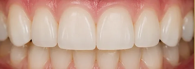Tooth re-shaping — subtle refinements, beautiful results — after