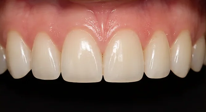 Tooth re-shaping and re-contouring — after