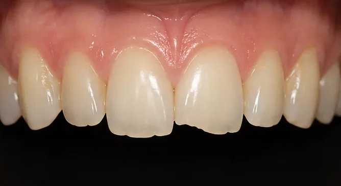 Tooth re-shaping and re-contouring — before