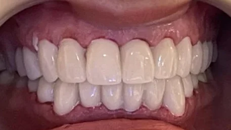 Dental crowns straighten crooked teeth without braces — after