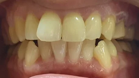 Dental crowns straighten crooked teeth without braces — before