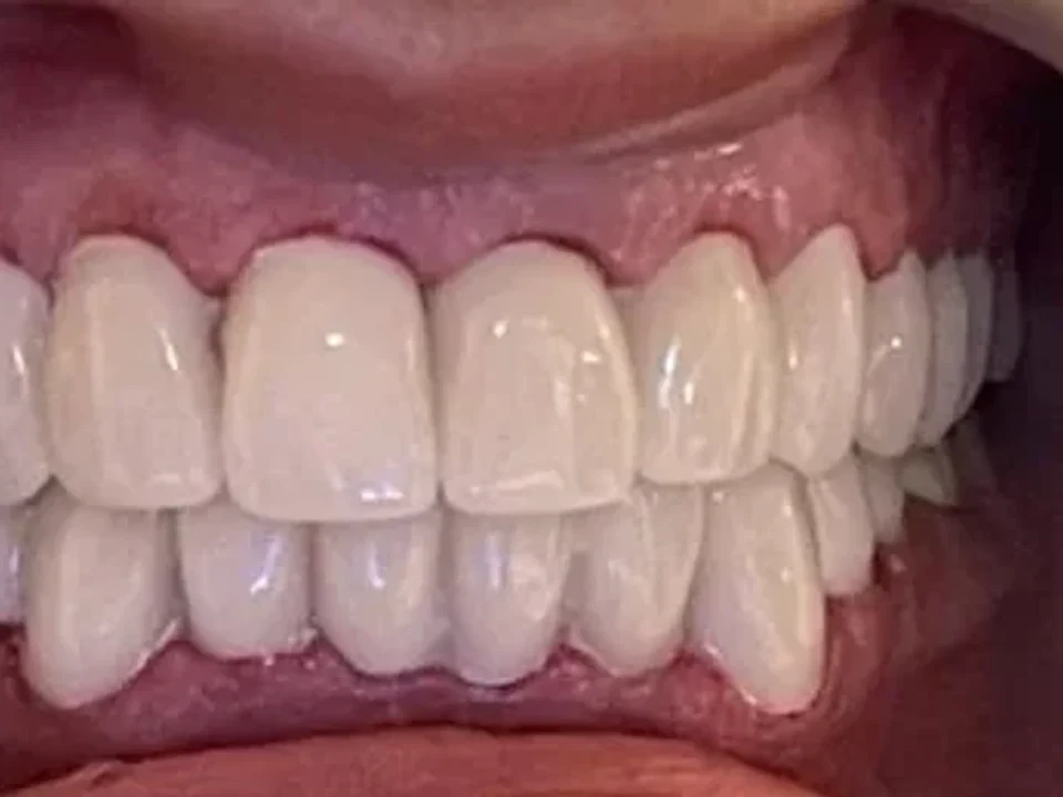 Dental crowns straighten crooked teeth without braces — after