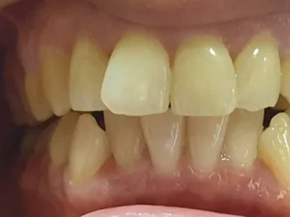 Dental crowns straighten crooked teeth without braces — before