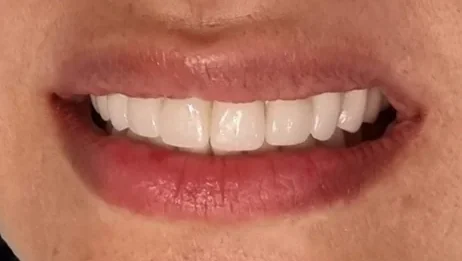 Worn, gapped front teeth restored with crowns — after