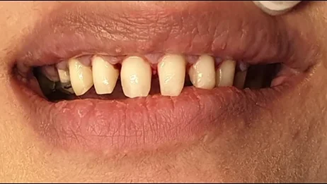 Worn, gapped front teeth restored with crowns — before