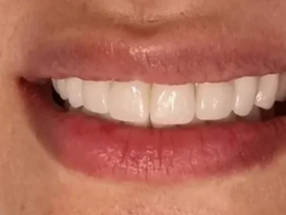 Worn, gapped front teeth restored with crowns — after
