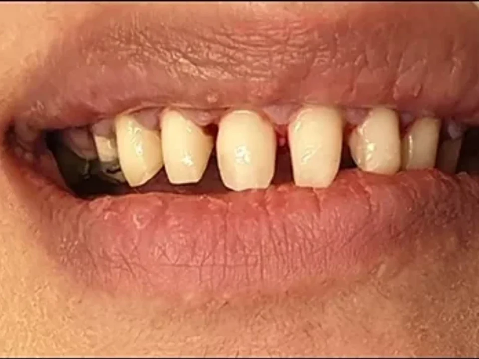 Worn, gapped front teeth restored with crowns — before