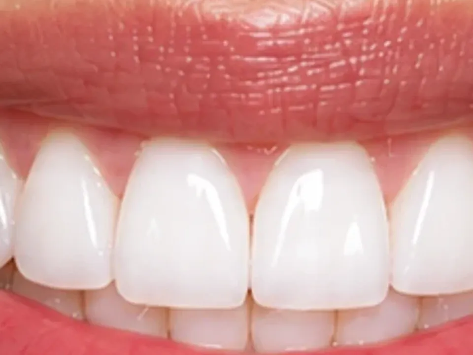 Discolored and decayed teeth restored — after