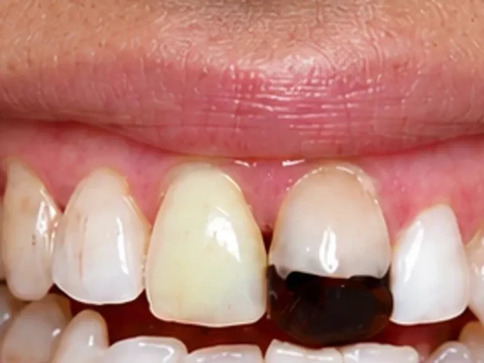 Discolored and decayed teeth restored — before