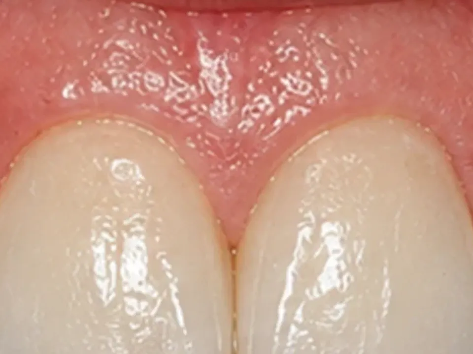 Gaps between teeth closed for a continuous smile — after