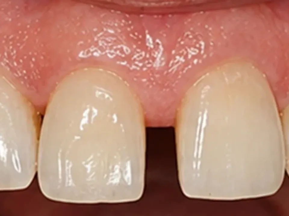 Gaps between teeth closed for a continuous smile — before
