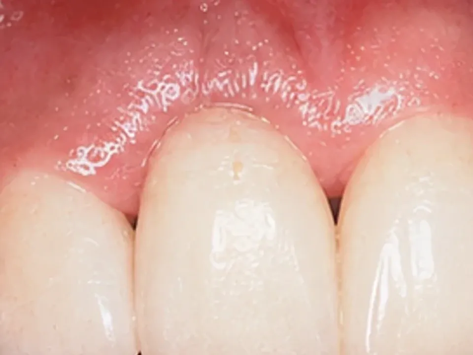 Missing teeth restored with a smile makeover — after