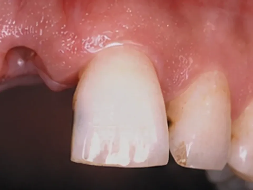 Missing teeth restored with a smile makeover — before