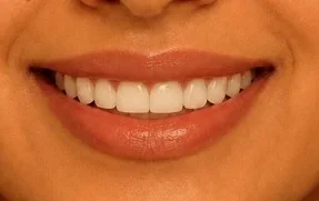 Hollywood smile makeover — after