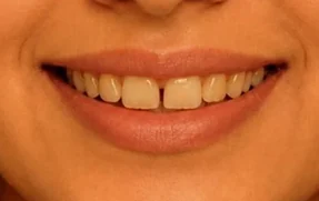 Hollywood smile makeover — before