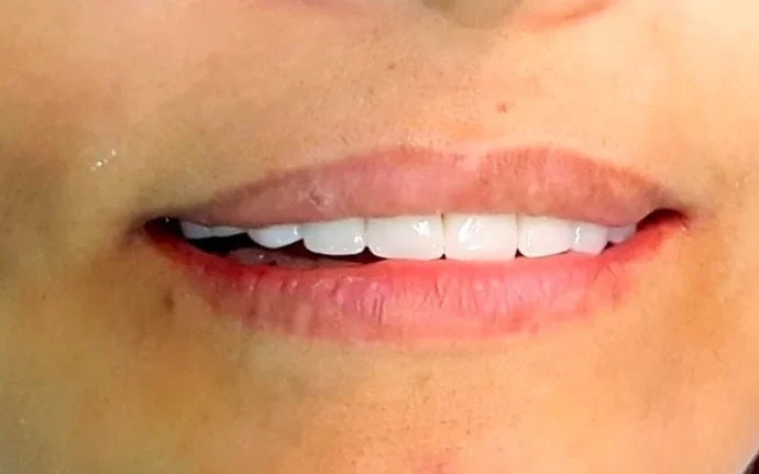 Full smile transformation — after