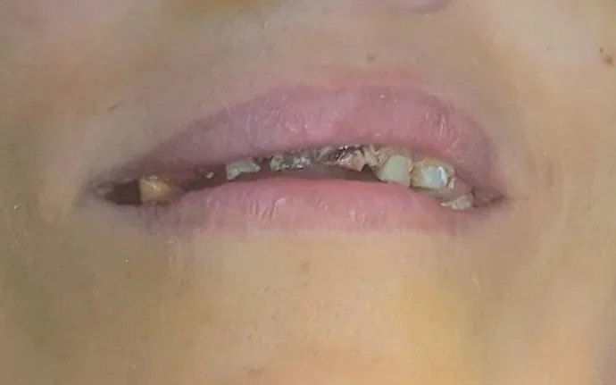 Full smile transformation — before
