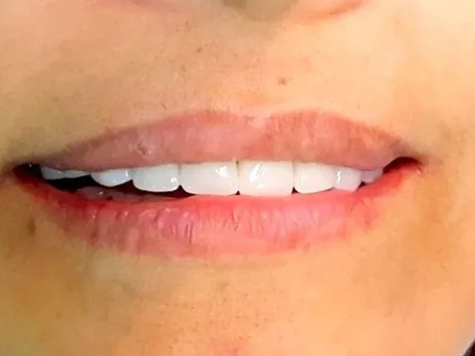 Full smile transformation — after