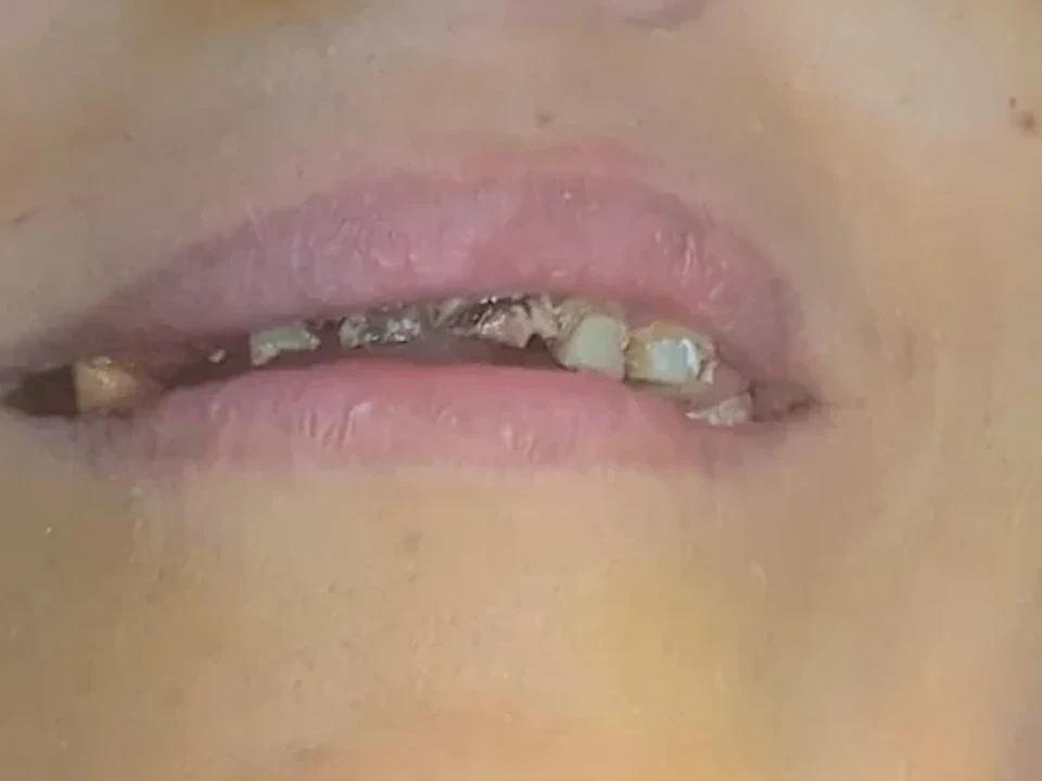 Full smile transformation — before