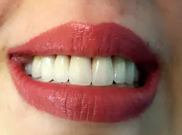 Natural smile ready for aesthetic refinement — after