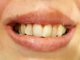 Natural smile ready for aesthetic refinement — before