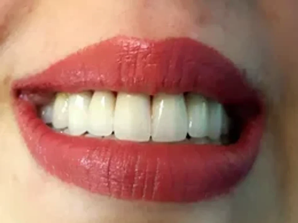 Natural smile ready for aesthetic refinement — after